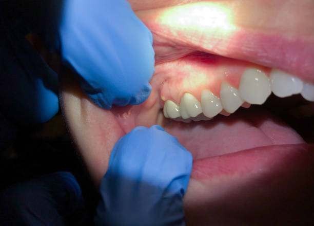 Best Emergency Gum Treatment in Clifton, CO